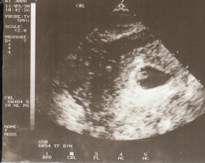 sonogram-first pictrue of Ansted
